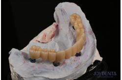 China Dental Restorations Multiple Teeth Implant Endosseous Replace Two Front Teeth supplier