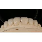 Precise Zirconia Crown Bridge Comfortable Fit / Esthetics 3-4 Days Quick Turnaround Time for sale