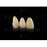 Durable Hypoallergenic EMAX Bridge Extreme Esthetics Emax Dental Bridge
