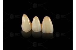 China Durable Hypoallergenic EMAX Bridge Extreme Esthetics Emax Dental Bridge supplier