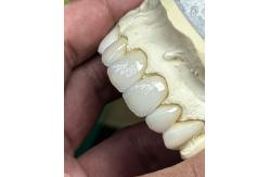 China Transluency Layered Zirconia Crown for Optimal Functionality and Natural Aesthetics supplier
