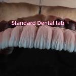 Zirconia Implant Bridge Screw Retained With Pink Gum Porcelain for sale