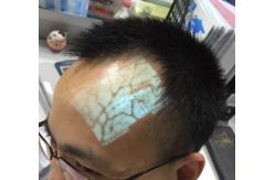 China Medical Professional Infrared Vein Viewer Transilluminator Find Veins For Phlebotomy supplier