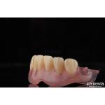 Personalized Invisible Denture Finished With Advanced Tooth Arrangement Technology