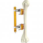 Medical Orthopedic Surgical Instruments Humeral Shaft External Fixator for sale