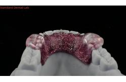 China Teeth Expansion And Distalization Adjusting Expander In Mouth Orthodontist Palate Expander supplier
