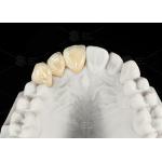 Durable Hypoallergenic EMAX Bridge Extreme Esthetics Emax Dental Bridge