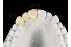 China Durable Hypoallergenic EMAX Bridge Extreme Esthetics Emax Dental Bridge supplier