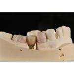 Sandblasted Single Tooth Implant With Self Tapping Thread And Internal Hex Connection for sale
