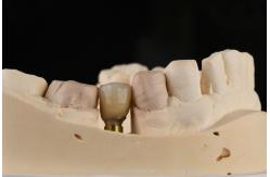 China Sandblasted Single Tooth Implant With Self Tapping Thread And Internal Hex Connection supplier