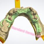 Metal Framework Design Laser Printing Cast Chrome Partial Denture Ni Be Free for sale