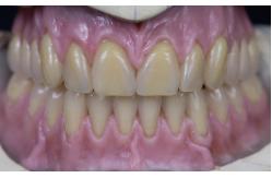China Hot Cured Full Arch Removable Acrylic Full Denture supplier
