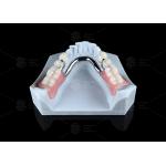 Adjustable Multi Functional ERA Precision Attachment Removable ERA Attachments For Dentures for sale