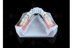 China Adjustable Multi Functional ERA Precision Attachment Removable ERA Attachments For Dentures supplier