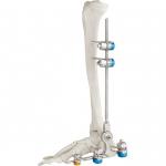 Medical Bone Hammer External Fixation Device Ankle Fracture for sale