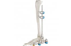 China Medical Bone Hammer External Fixation Device Ankle Fracture supplier