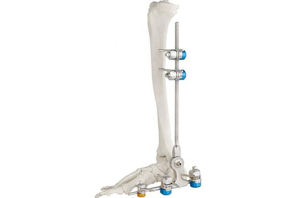 Medical Bone Hammer External Fixation Device Ankle Fracture