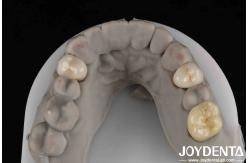 China Easy Cementation Emax Inlay Onlay Medium Strength Natural-looking Esthetics supplier