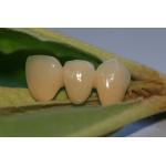 ISO13485 Good Biocompatibility PFM Non Precious Dental Crown for sale