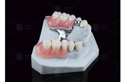 China Dental Prostheses Key Way Attachment Precision Attachment Adjustable Retentive Force supplier