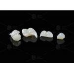 Translucent Onlay Zirconia Inlay For Long Lasting Stain And Wear Resistance