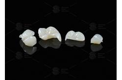 China Translucent Onlay Zirconia Inlay For Long Lasting Stain And Wear Resistance supplier