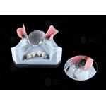 0.1mm Tolerance CEKA REVAX Attachment Titanium 3mm Vertical Clearance for sale