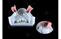 China 0.1mm Tolerance CEKA REVAX Attachment Titanium 3mm Vertical Clearance supplier