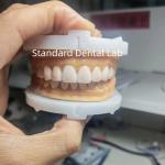 Perfect Esthetics Provisional Wax Up for Dental Professionals using dental wax from China Dental Lab for sale