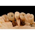 Self Tapping 3.0mm Thread Dental Titanium Implant Optimized Functionality for sale