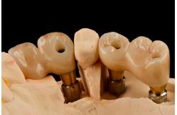 China Self Tapping 3.0mm Thread Dental Titanium Implant Optimized Functionality supplier