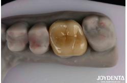China Medium Translucency Emax Inlay Onlay Easy Cleaning And Non-toxic Biocompatibility In Materials supplier