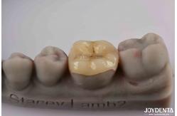 China Customizable Zirconia Inlay Onlay Minimal Preparation For Damaged Teeth Restoration supplier