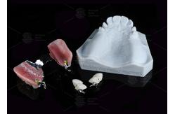China Dental Prostheses Key Way Attachment Precision Attachment Adjustable Retentive Force supplier