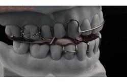 China Teeth Expansion And Distalization Adjusting Expander In Mouth Orthodontist Palate Expander supplier