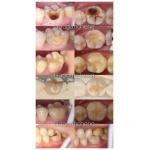 Porcelain Dental Inlay Restorative For Adults And Children Exceptional Performance for sale