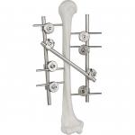 Titanium Humeral External Fixation Device Orthopedic Surgical Implant for sale