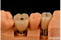 China Customizable Implant Crown and Bridge Achieve a Natural Look with Long-lasting Results supplier