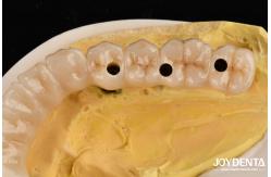 China Unmatched Accuracy Zirconia Implant Bridge Commitment To Comfort supplier