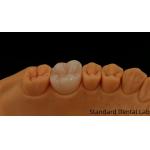 Noritake Porcelain Full Contour Zirconia Crown Customized Vita Shade for Esthetic Digital Dental Restoration by Dental Lab for sale