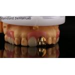 Full Acrylic Dentures With Yellow Gold Teeth/Dental Temporary Acrylic Denture Ivoclar Professional FDA Approved for sale