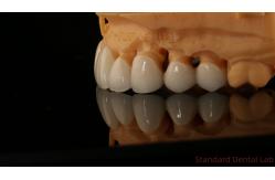 China Full Contour Dental Lab Crowns High Translucency Solid Zirconia Crown China Dental Lab supplier