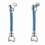 Precice Ti Alloy Surgery Interlocking Nail Femur Mechanical Stable for sale