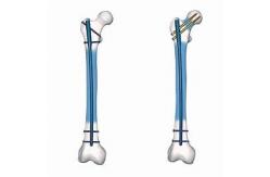 China Precice Ti Alloy Surgery Interlocking Nail Femur Mechanical Stable supplier
