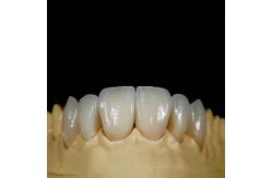 China High Translucency Emax Porcelain Veneers Crown with Better Materials by Ivoclar Vivadent supplier