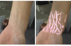 China Medical Professional Infrared Vein Viewer Transilluminator Find Veins For Phlebotomy supplier