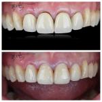 Comfortable Zirconia Dental Bridges Lightweight Natural Color Transitions For Optimal Patient Experience for sale