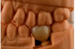 China Oral Implantology Self Tapping Single Tooth Dental Implants With Internal Hex Connection supplier