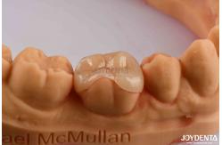 China High Durability Dental Inlay Onlay Composite Natural Looking Appearance supplier