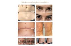 China 15ml Semi Permanent PMU Pigment Skin Remodeling Scars Remove White Freckles Vitiligo supplier